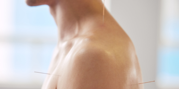 Dry needling Fysiotherapie Merenwijk