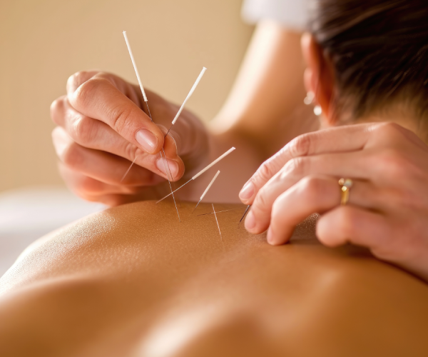 Dry needling Fysiotherapie Merenwijk