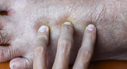 Oedeemtherapie Fysiotherapie Merenwijk 