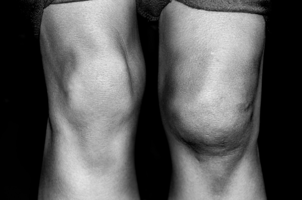 vocht in knie Joint Care