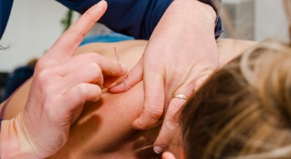 Dry needling